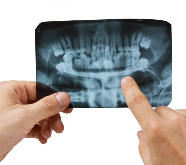 Bellevue 7 Signs You Need Endodontic Surgery