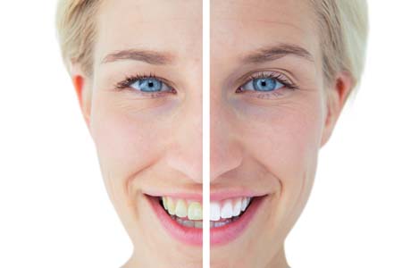 Teeth Whitening in Bellevue, WA at Lifetime Smiles