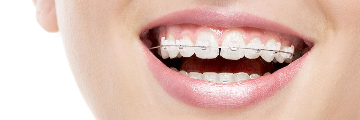 https://www.implantdentalbellevue.com/wp-content/uploads/clear-braces-header.jpg