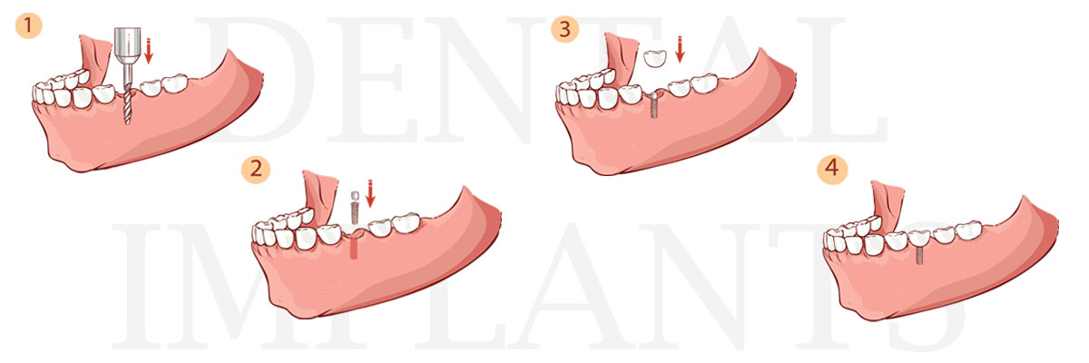Bellevue The Dental Implant Procedure