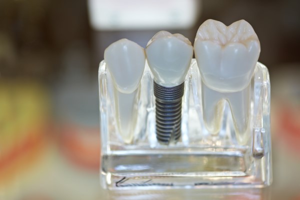 Dental Implants Bellevue, WA