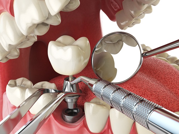 dental implant Bellevue, WA