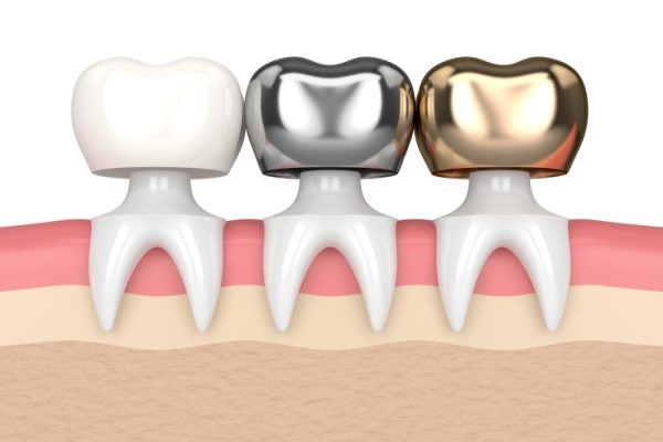 Dental Restorations Bellevue, WA