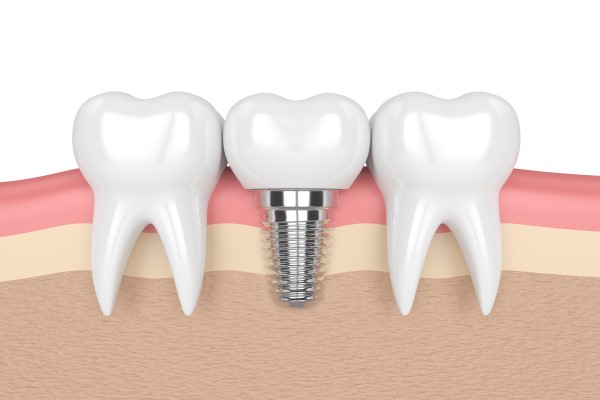 Implant Dentist Bellevue, WA