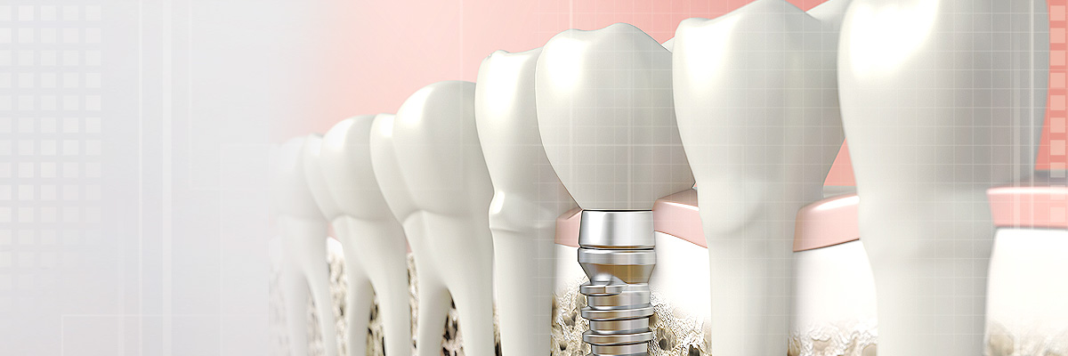 Bellevue Implant Dentist