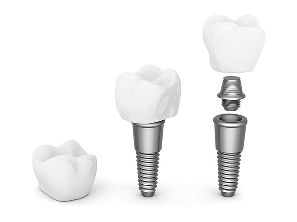 Implant Restoration