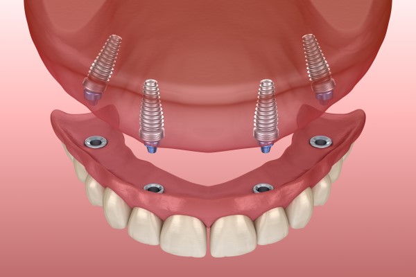 Implant Supported Dentures Bellevue, WA