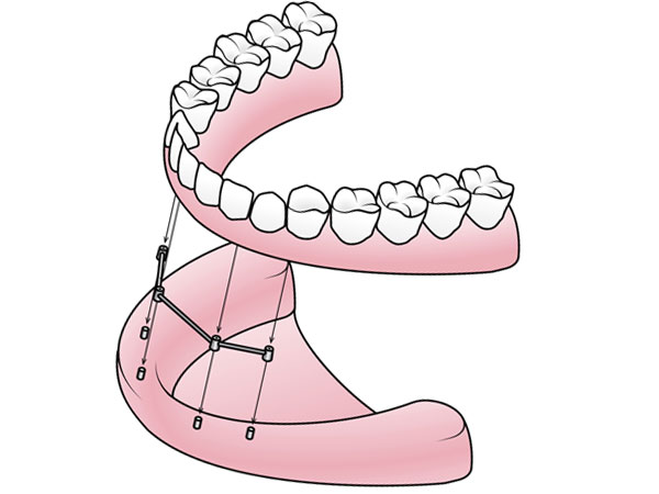 Partial Dentures in Bellevue, WA - Bellevue Dentist