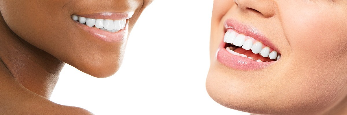 Bellevue Teeth Whitening