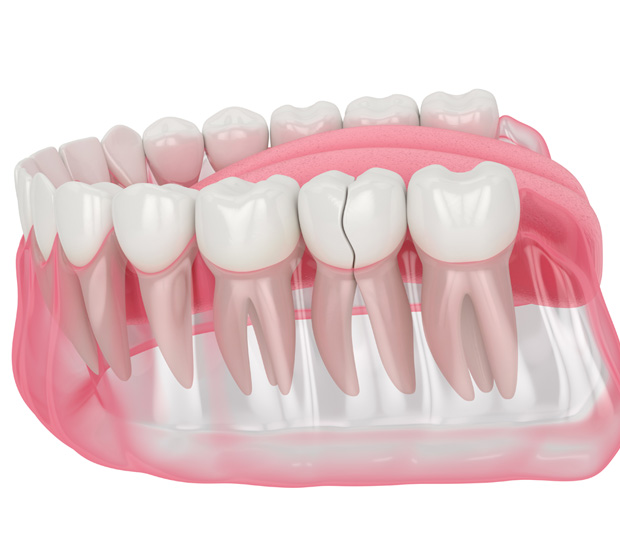 Bellevue Types of Dental Root Fractures