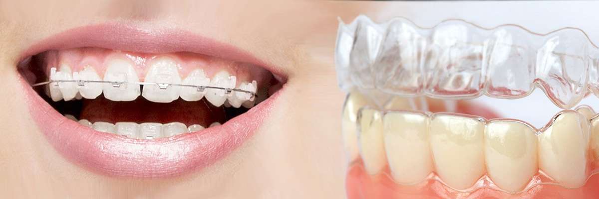 Bellevue Which is Better Invisalign or Braces
